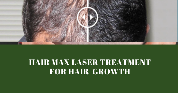 Get A Laser Treatment For Hair Growth At Hairmax